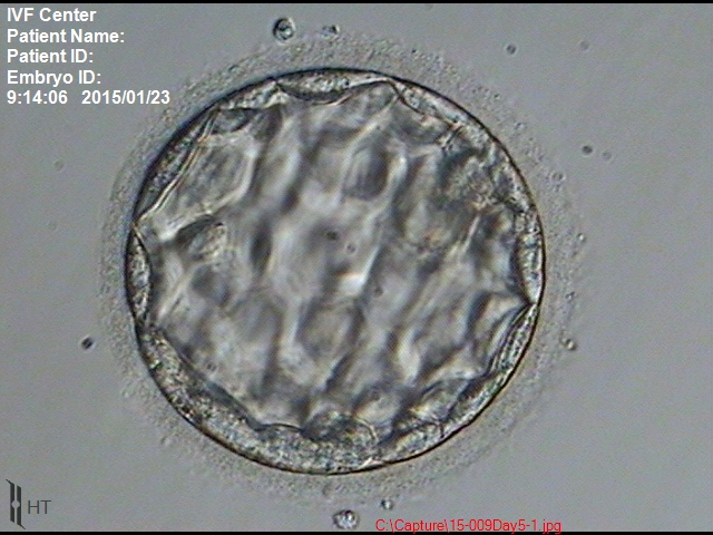 拡張期胚盤胞